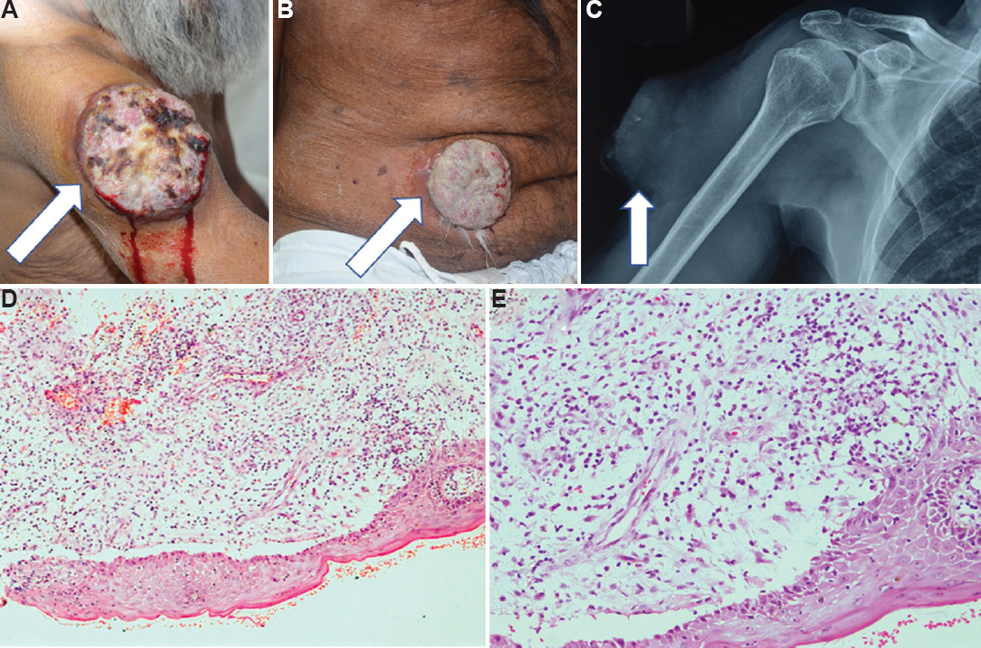 Cutaneous lesion on the (A) shoulder and (B) over abdomen. (C) X-ray showing cutaneous lesion with no bone destruction. Immunohistochemistry of the diopsy from the lesion (D) ×10 and (E) ×20 revealed tumour positive for LCA and CD138 while negative for CK7, CK20, TTF1, synaptophysin and AE1/AE3 malignancy with plasmablastic differentiation.